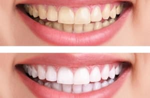 Blanqueamiento Dental
