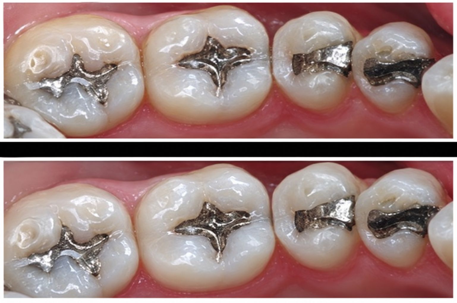 Calzas Dentales