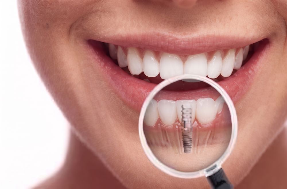 Implantes Dentales en Cúcuta